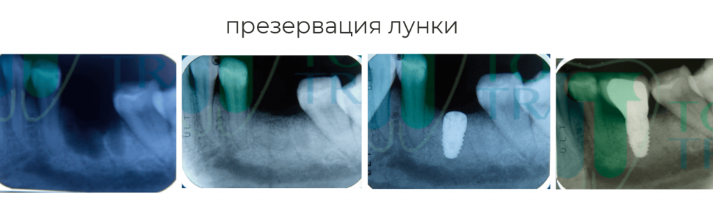 презервация лунки